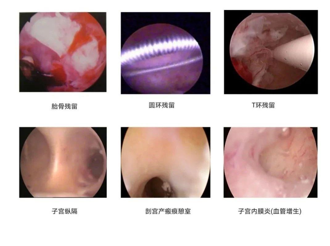 取完卵需要做宫腔镜检查么,宫腔出血需要做宫腔镜检查吗