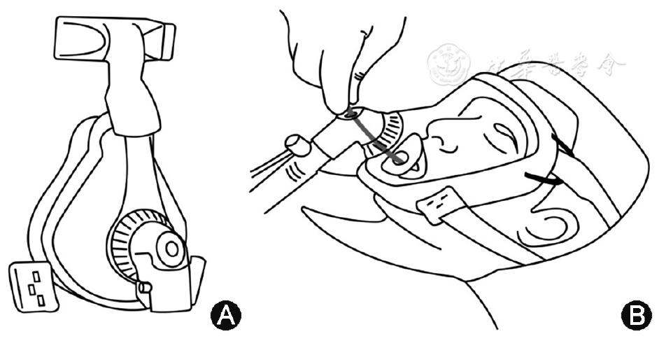 icu患者肺栓塞应急预案演练脚本,肺泡灌洗液标本标准