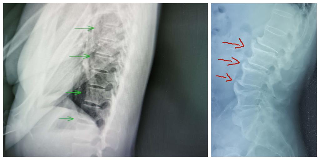 中医院看骨质增生怎么样,挂什么科室可以治骨质增生
