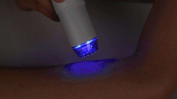 痘痘挤出黄水还是血水,痘痘挤出来的白色乳浆是什么