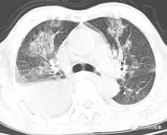 肺炎的最佳治疗方法及药物,肺炎的治疗方法和流程