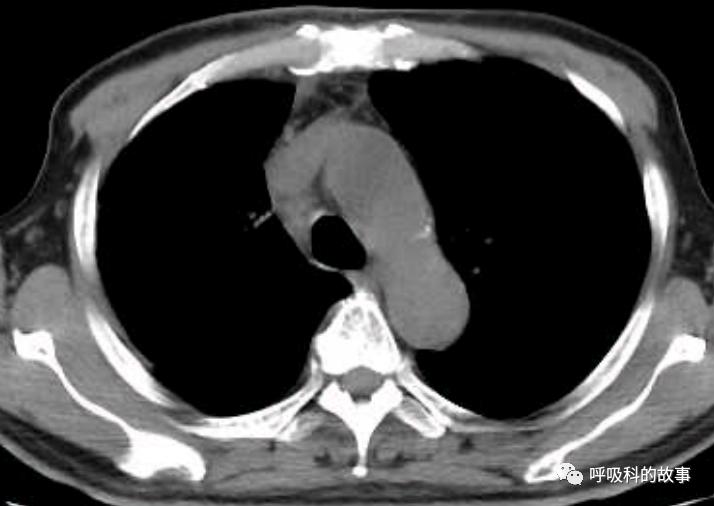 我是如何诊治肺炎的？（4）——如何理解抓住关键信息（2）