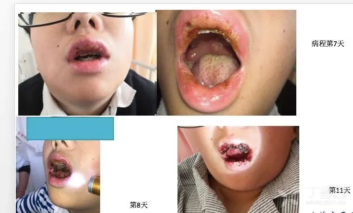 扁桃体化脓反复发烧最快的偏方,幼儿扁桃体化脓高烧不退怎么办