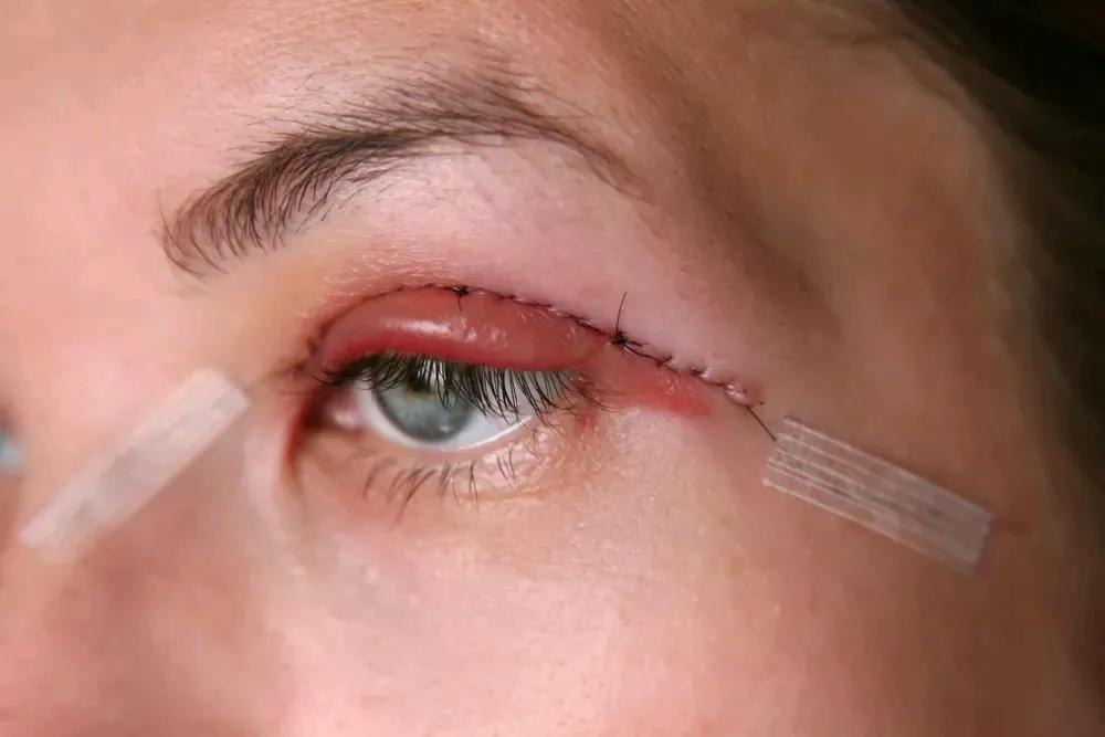 贴上就能消除疤痕是真的吗,脸上有疤如何淡化疤痕