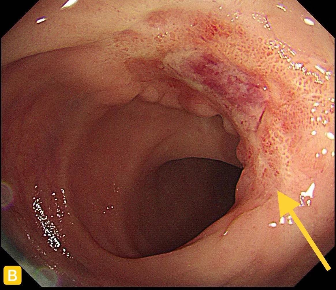直肠癌术前放疗肛口溃烂,直肠癌科普文章模板