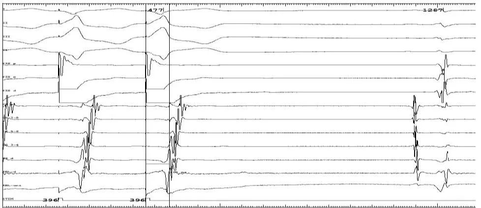 航天中心医院射频消融,航天中心医院介入手术