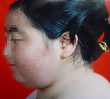 为什么体重下降反而脸变圆了,突然脸圆了一圈体重降了