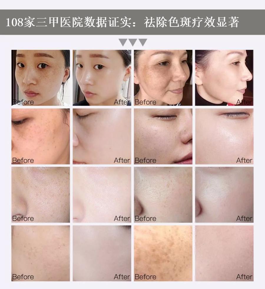 花了3万做激光,才彻底懂了:医生为什么劝你别去斑