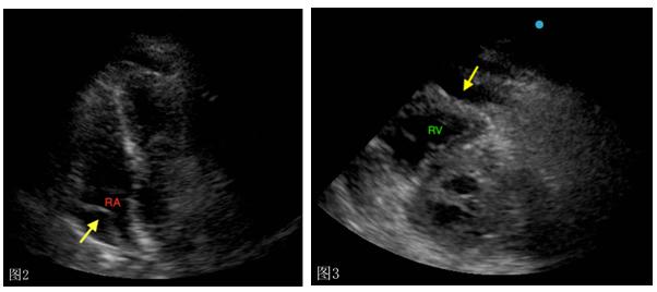 流感病毒会引起心脏问题吗,病毒引起的心脏罕见病