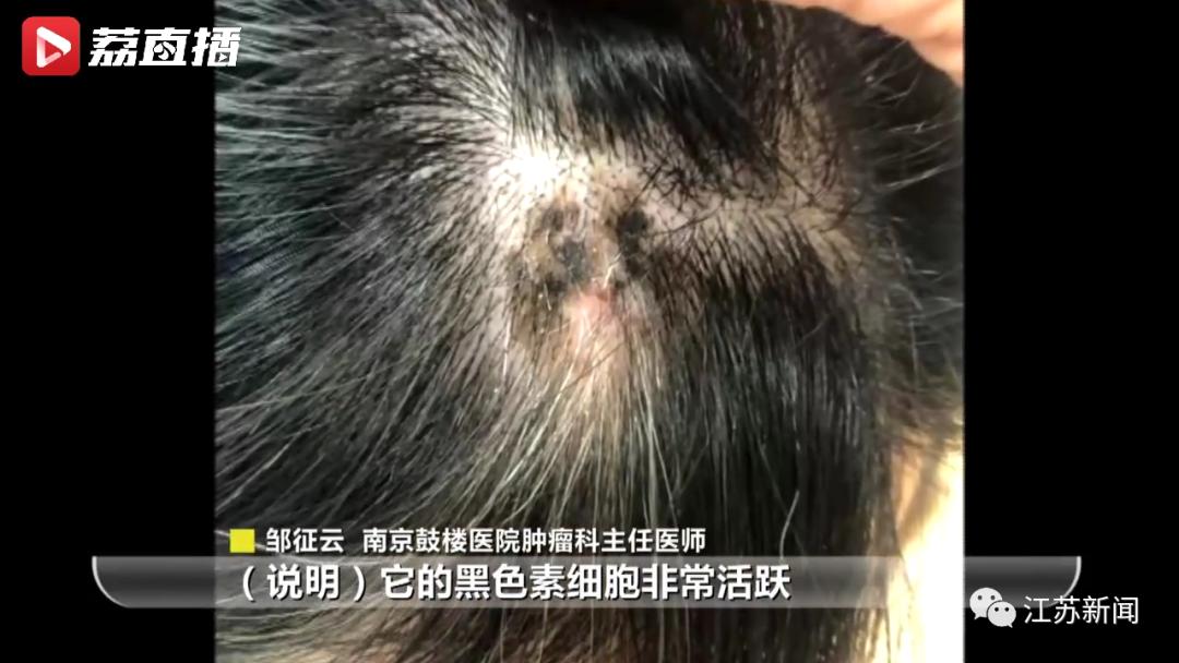 头皮上的黑痣要不要紧,头皮好多小色素痣怎么办