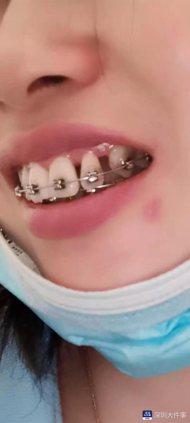 轻度中度重度矫正牙齿,修复牙龈萎缩牙缝大的牙膏靠谱吗