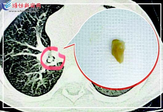 孩子喉咙有颗粒,孩子喉咙里有痰鸣音怎么回事