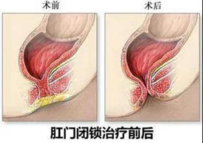 婴儿直肠阴瘘怎么护理,婴儿先天性直肠阴道瘘有什么症状