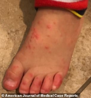 抗病毒治疗阿昔洛韦,抗病毒药膏阿昔洛韦