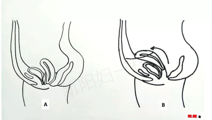 女子子宫脱垂如何保健恢复,省人民医院妇科治疗子宫脱垂
