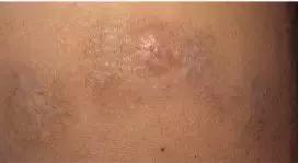 纹身的激光治疗,激光能祛纹身吗