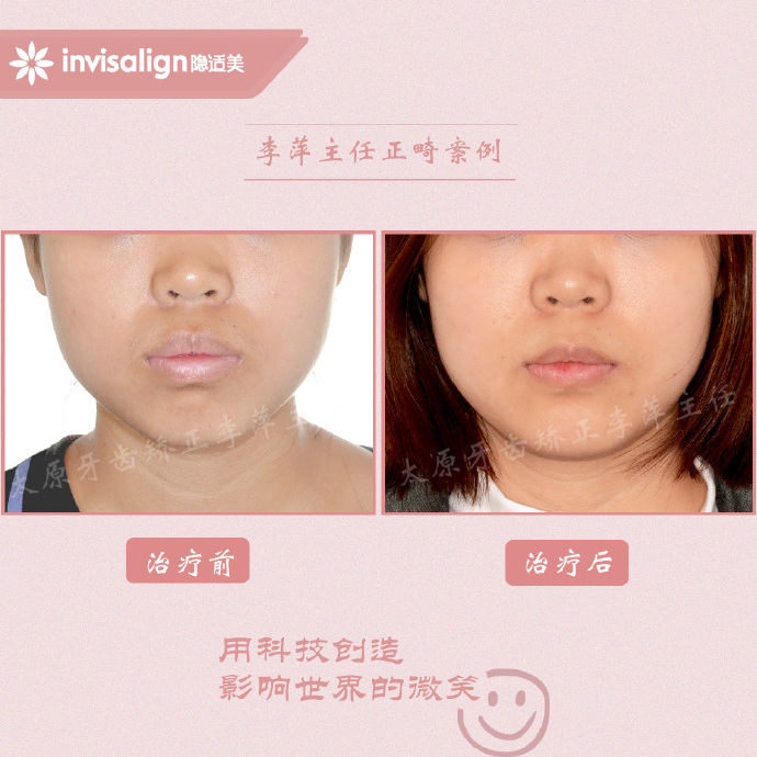 龅牙矫正牙齿能解决下颌后缩么,儿童正畸能解决鼻基底凹陷问题吗