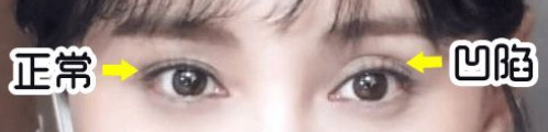 切眼袋会加速衰老的案例,割双眼皮衰老更快