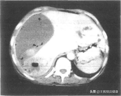 脓肿为什么会有硬结,肝脓肿和糖尿病的关系