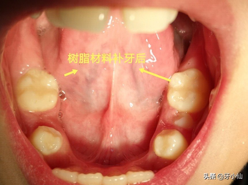 小孩子吃多了糖长虫牙,吃糖果不刷牙会有虫牙吗