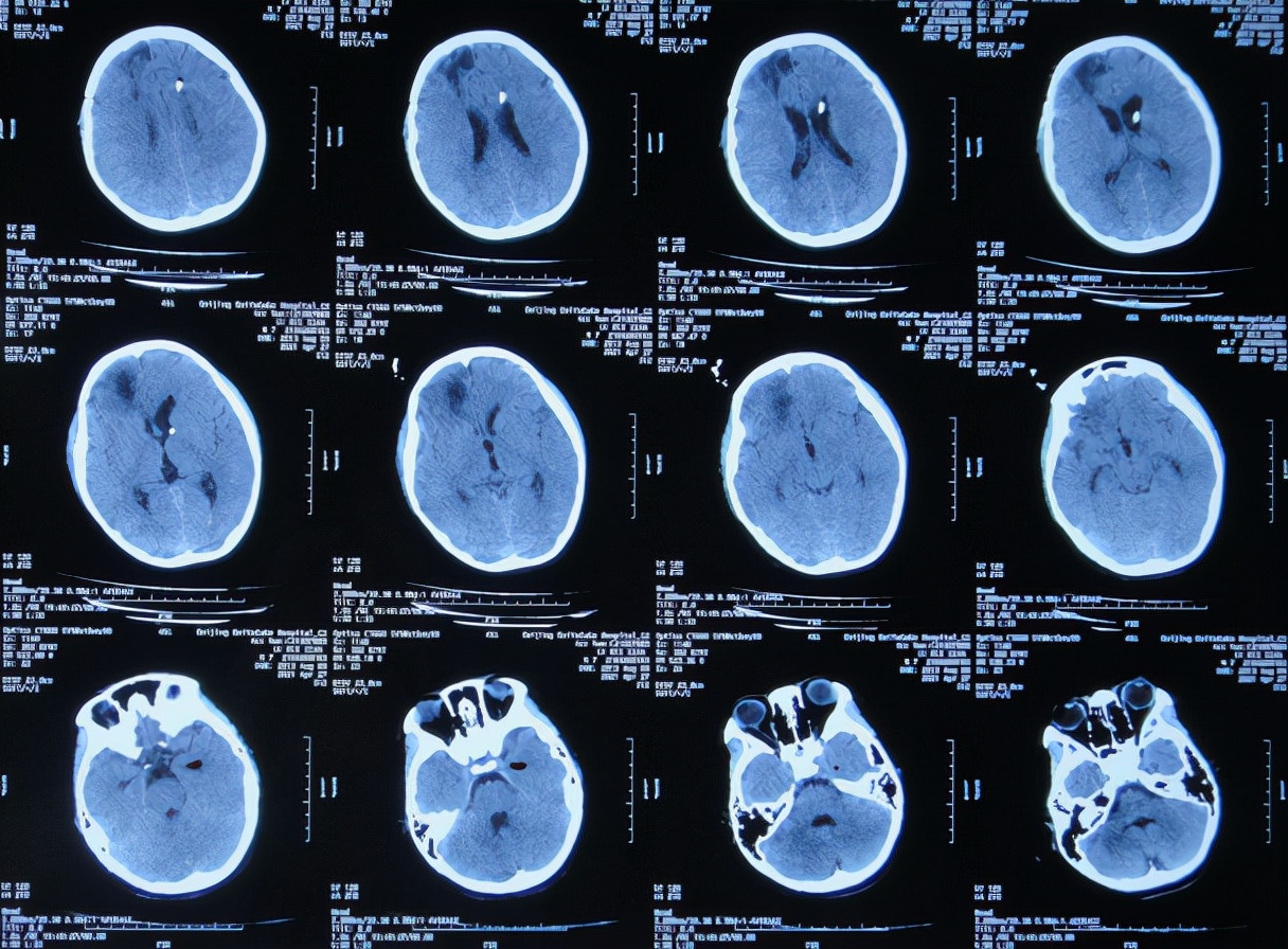 儿童脑出血昏迷三天后恢复正常了,脑出血后脑积水多久会出现症状