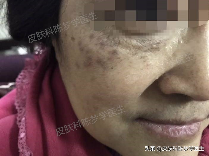 褐青斑是雀斑样痣吗,脸上太田痣怎么祛斑