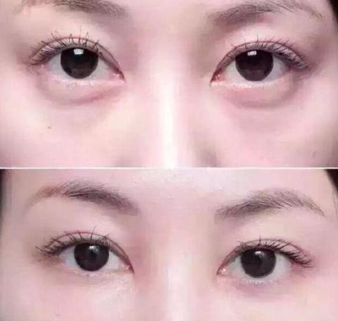 黑眼圈眼纹很重显老怎么办,黑眼圈重细纹多显老的女人