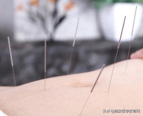 海外针灸,中医针灸真的那么神奇吗