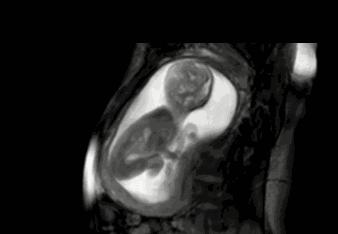 胎儿在几个月容易出现脐带绕颈,胎儿为什么会出现脐带绕颈的情况