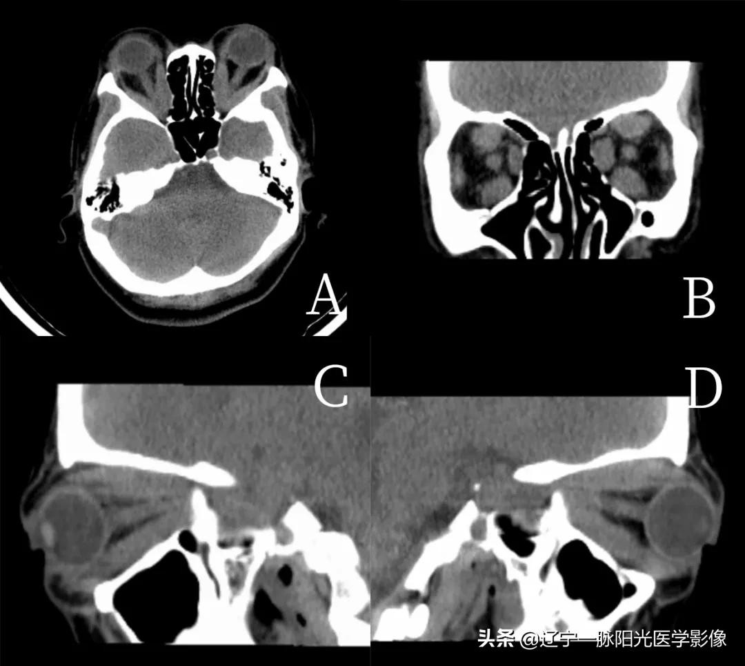 眼部肿瘤治疗有哪些,眼部肿瘤症状有哪些