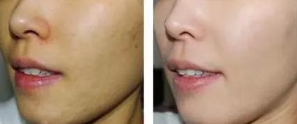 激光美白的效果一般怎么样啊,冷光美白和激光美白哪个效果好