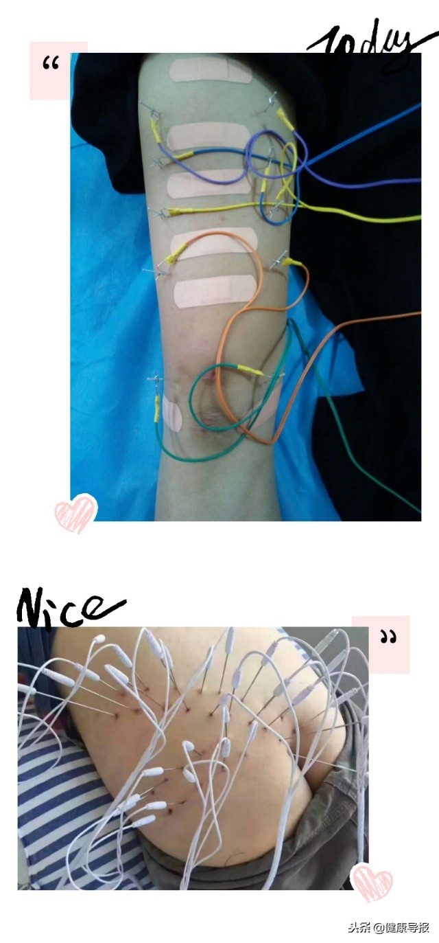 刀随心神走，效从指间出汉滨区南溪卫生院颜学生医生浅谈水针疗法