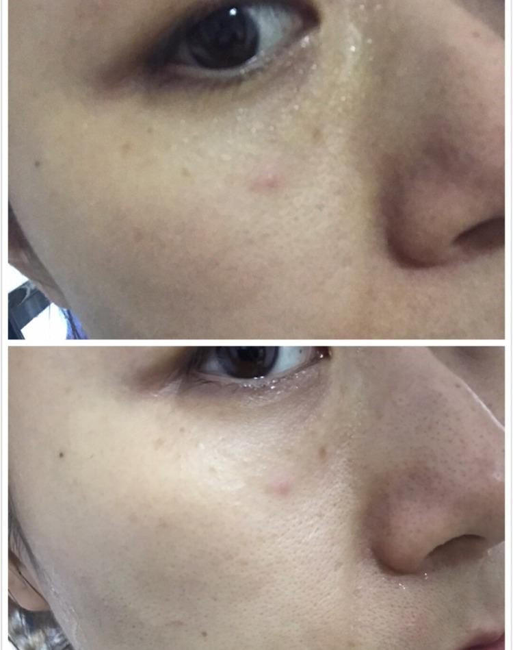 为啥要去脸部角质,为什么要去皮肤上的角质