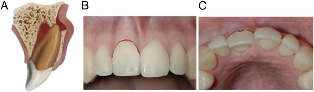 宝宝磕掉乳牙还能再长吗,宝宝磕掉牙会长出来吗