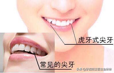 老虎牙可以戴牙套矫正吗,老虎牙做矫正