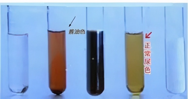 有没有比a3亚型血更珍贵的血型,稀有血型基因库