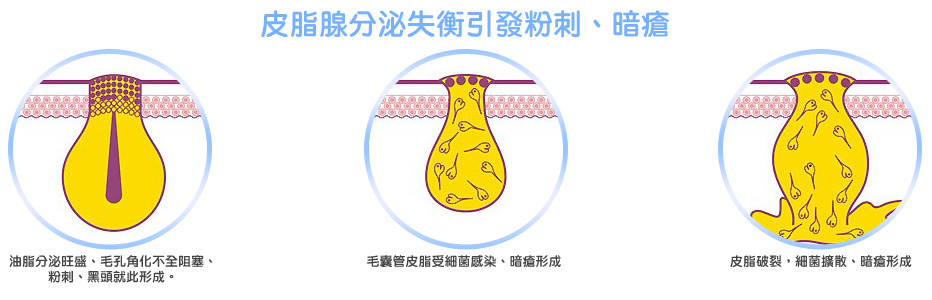 脸上长痘有没有快速除痘的方法,脸上长痘正确的护肤步骤