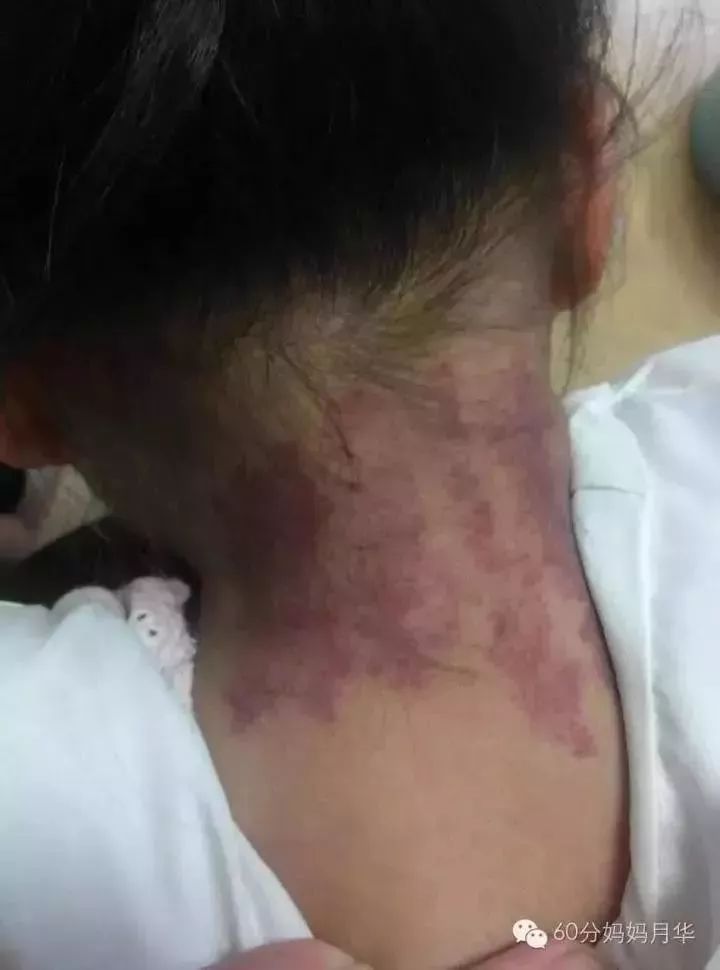 流感高峰期攻略,流感季节最有效的措施