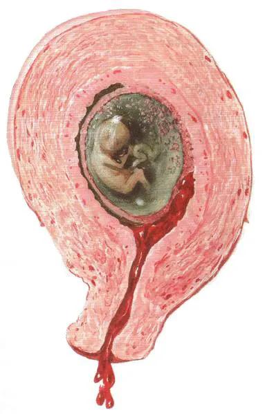 第5讲，先兆流产孕酮和HCG