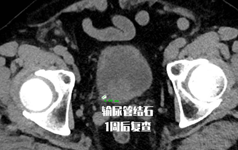 三毫米泌尿结石,泌尿系结石4个症状