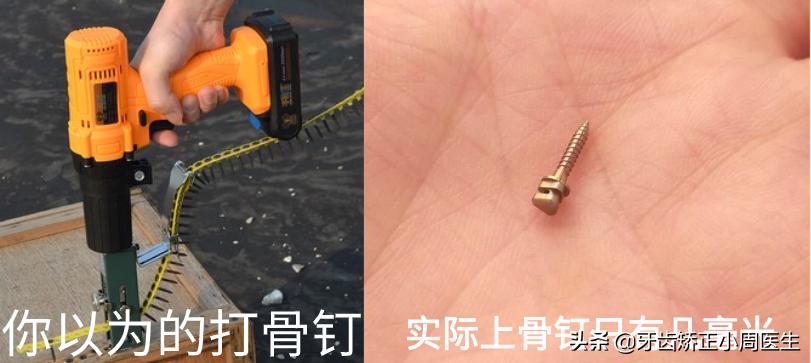 正畸牙齿打骨钉的危害,正畸打骨钉是什么感觉