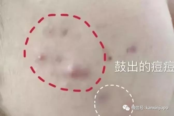 额头长闭口毛孔粗大爆痘怎么办,皮肤爆痘起闭口怎么回事