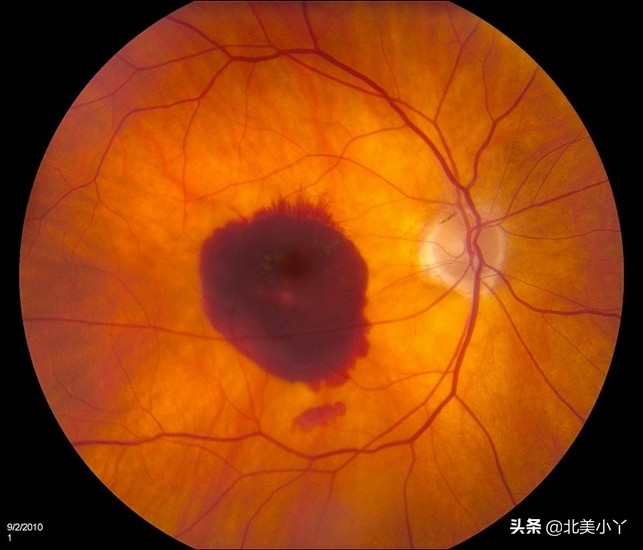 小丫医生说说“眼底出血”