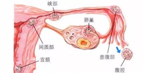 输卵管为什么会出现问题,输卵管结扎后想要二胎怎么办