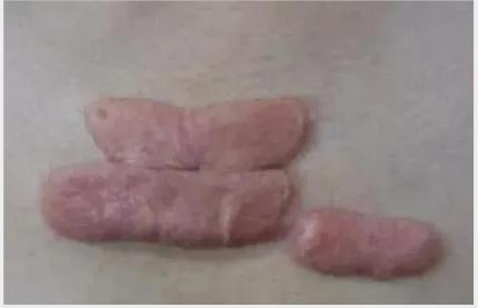 全国最权威做疤痕疙瘩医院,百德医院疤痕修复