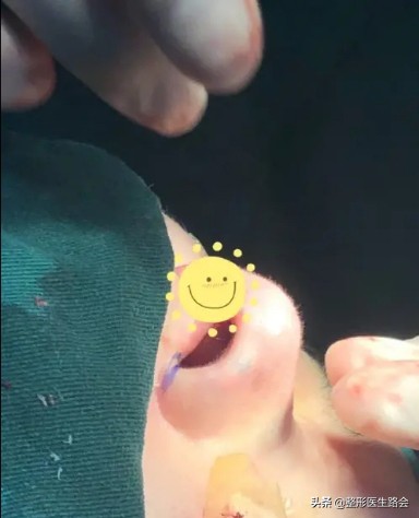 隆鼻前要问清楚的事,做隆鼻手术前你需要了解这些