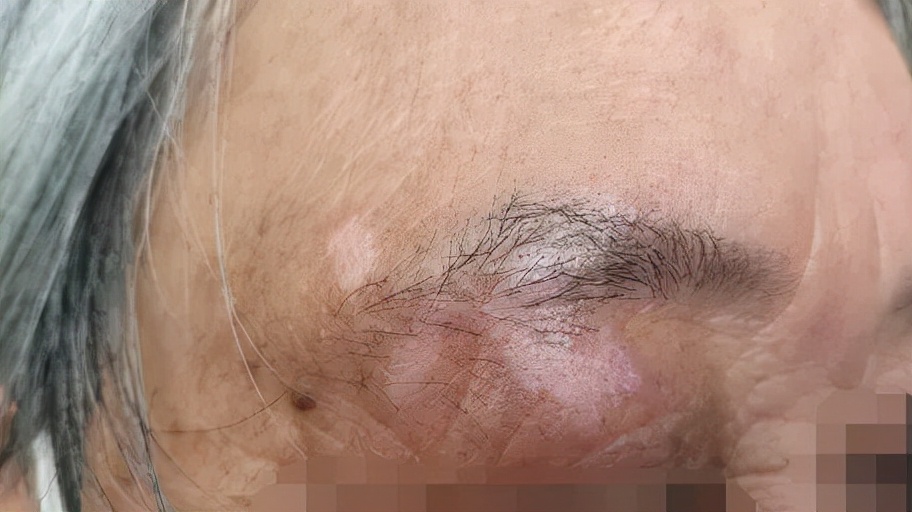 白癜风的正确看法,突然间长白癜风怎么回事