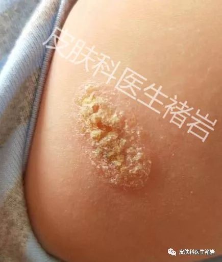 湿疹性皮炎长什么样,脸上湿疹长什么样