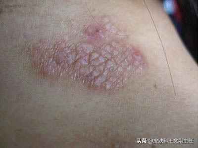 神经性皮炎的病因病机,皮肤神经性皮炎的病因是什么