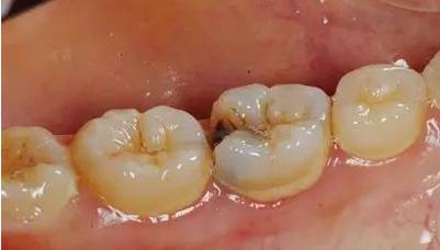 牙缝越来越大是什么导致的,牙缝越来越大什么病中医怎么说
